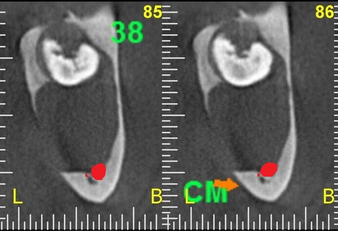 CLASSIFICAZIONE DEI   TUMORI ODONTOGENI BENIGNI e MALIGNI
