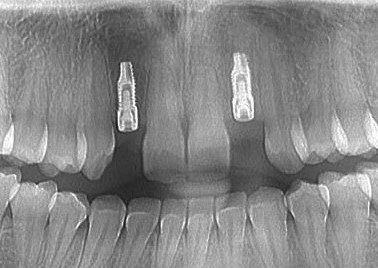 Impianti posizione incisivi laterali