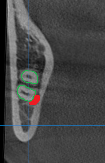 Nervo Alveolare Inferiore nella Cone Beam