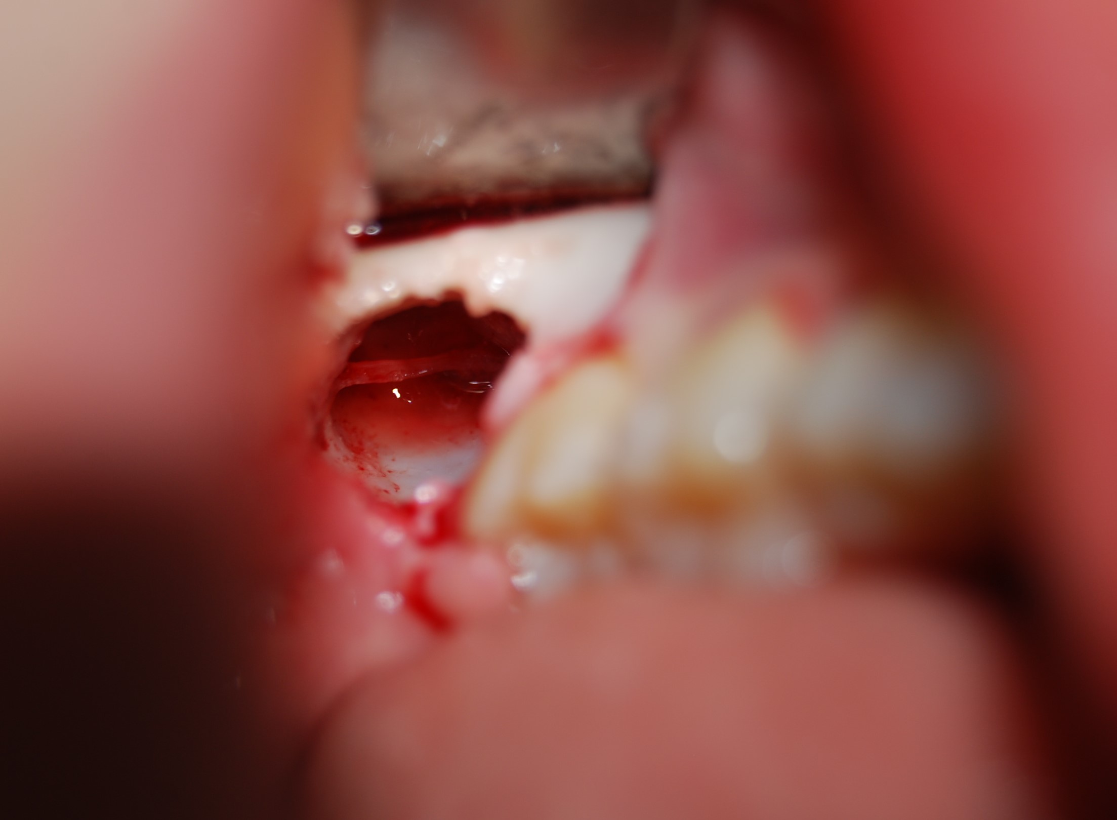Nervo alveolare inferiore (foto)