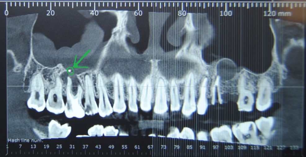 Sinusite odontogena bilaterale