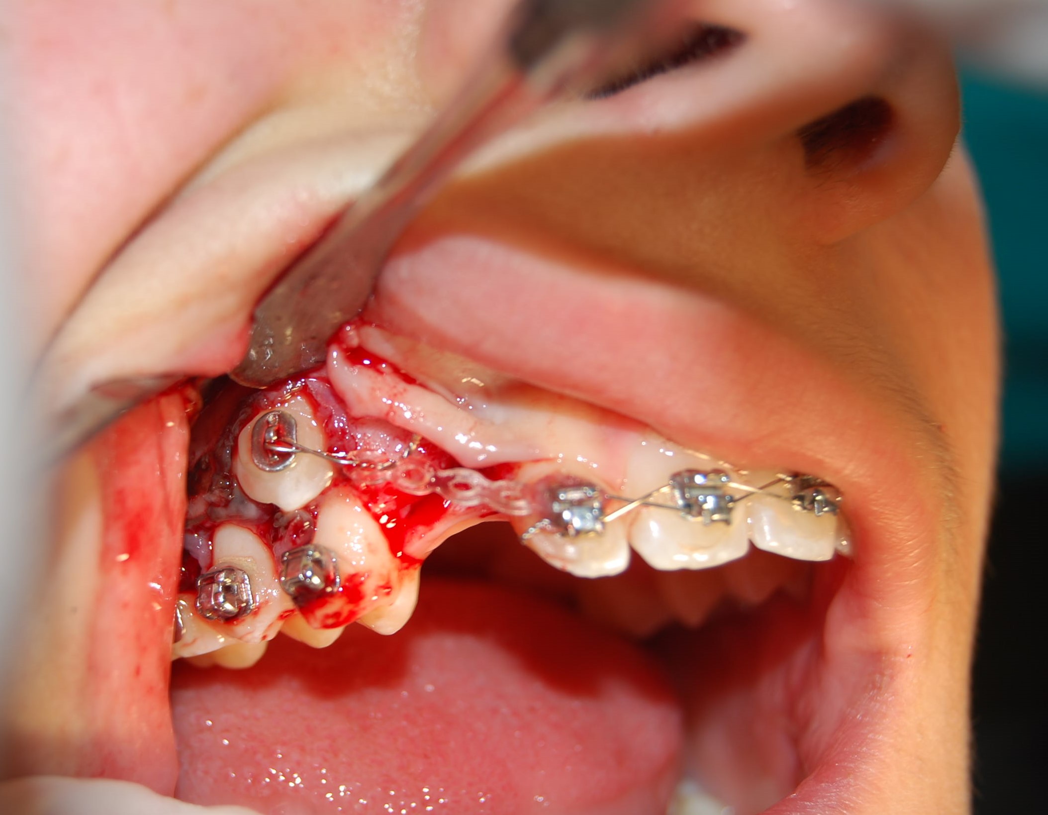 Approccio ortodontico alle TRASPOSIZIONI DENTALI arcata superiore