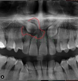 Canini inclusi ed ortodonzia