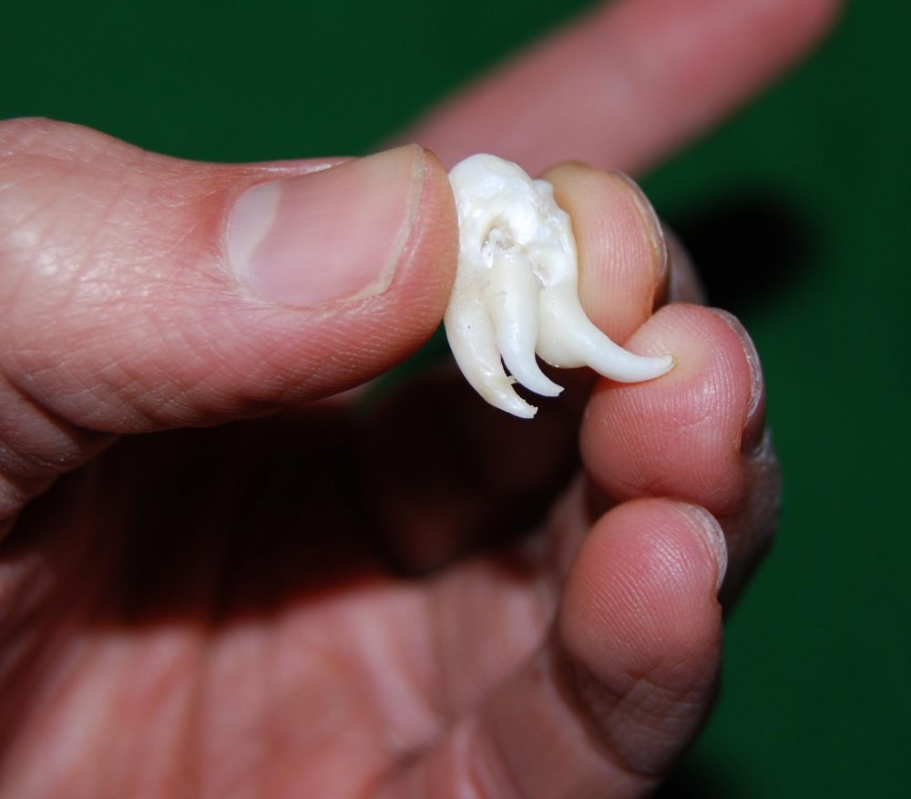Dente del Giudizio e radici prossime alla corticale linguale.