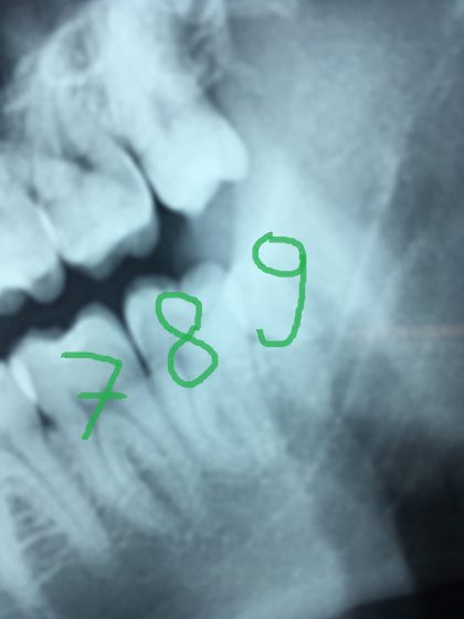 Dente del Giudizio e nono