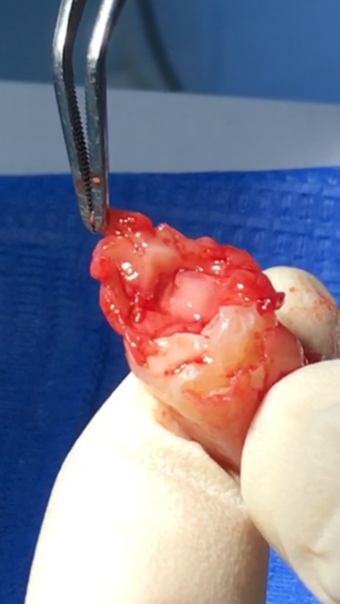 GERMECTOMIA del Dente del Giudizio