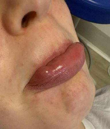 MUCOCELE