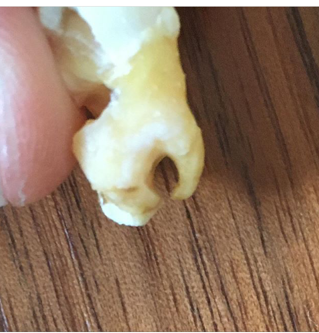 Nervo alveolare inferiore e rapporti con il 48