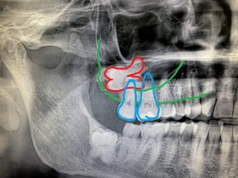Dente del Giudizio nel Seno Mascellare