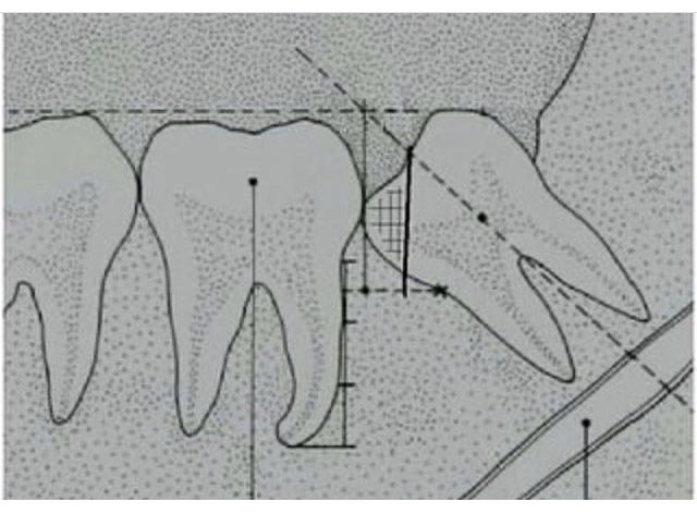 Odontotomia del dente del giudizio e Nervo Alveolare Inferiore