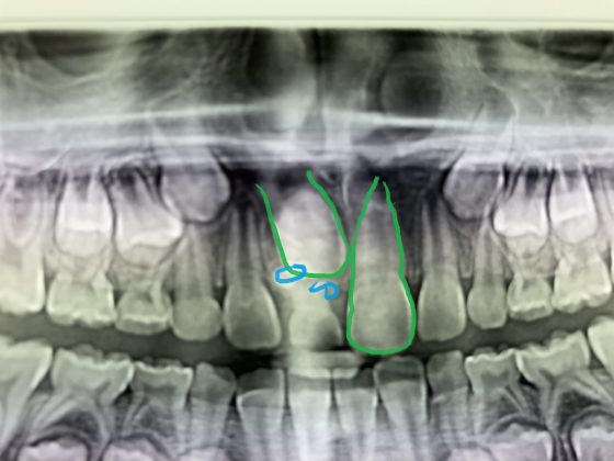 ODONTOMA COMPOSTO
