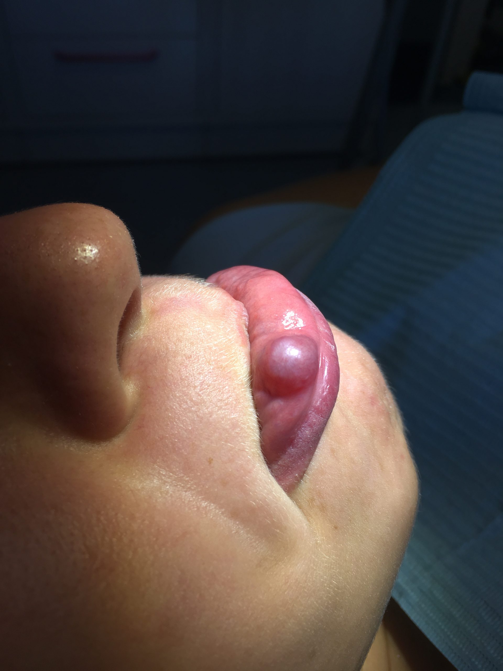 Mucocele