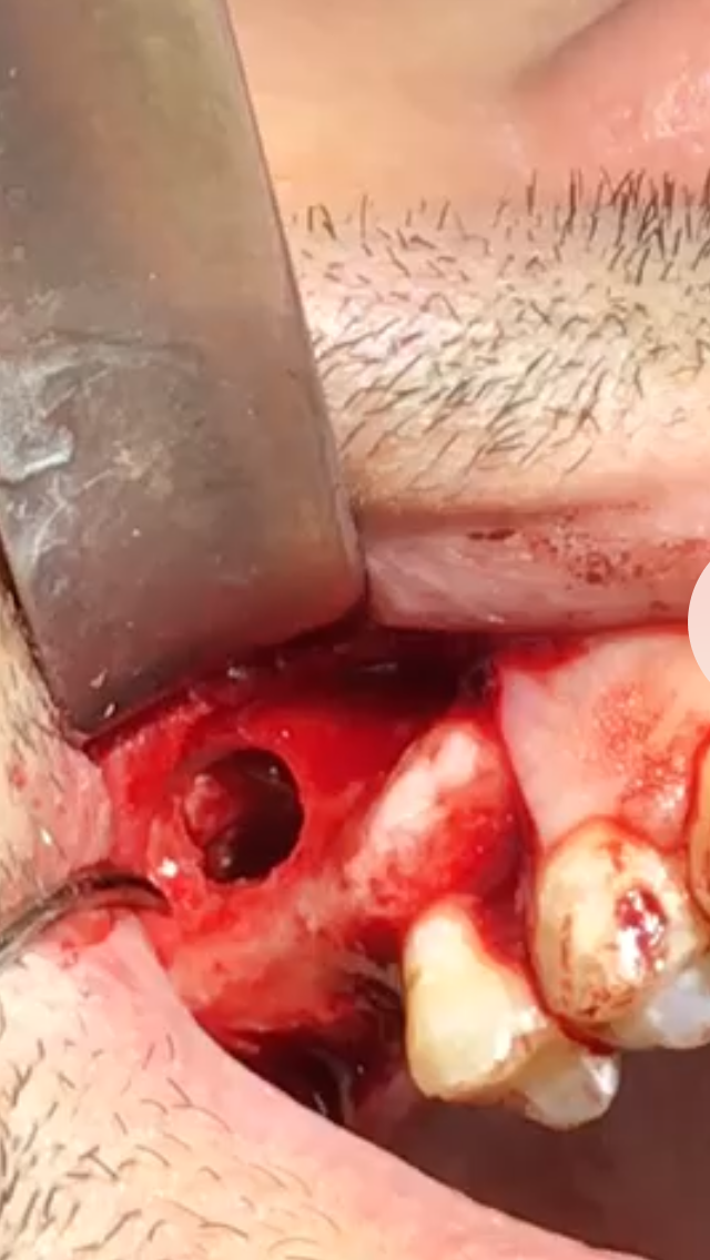 Rialzo del Seno Mascellare