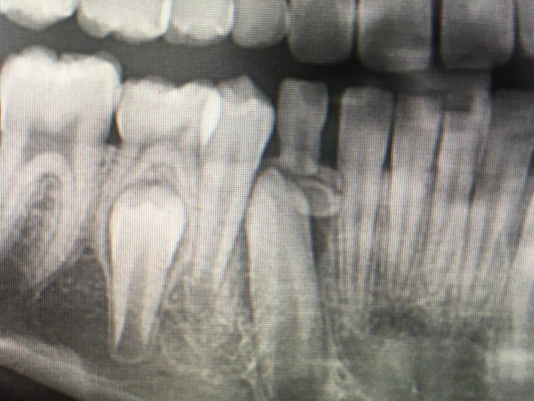 Odontoma composto