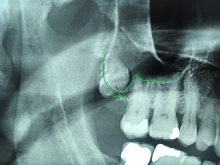Dente del giudizio e sinusite odontogena