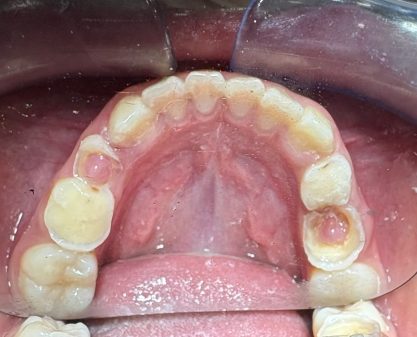 Carie denti da latte