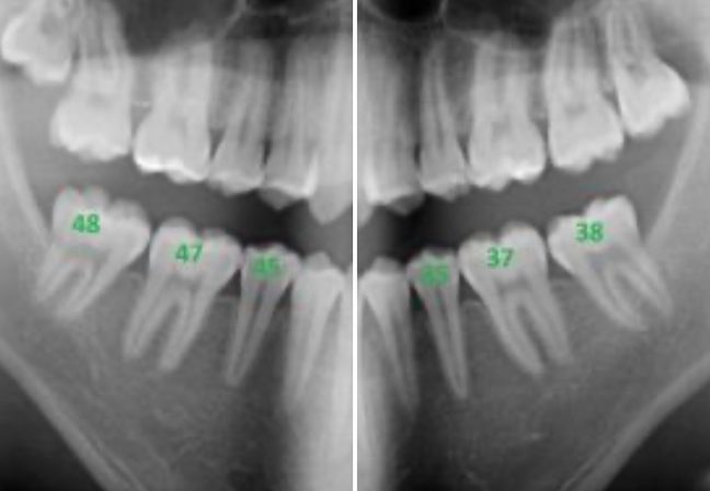 Mesializzare 4 denti nella mandibola