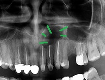 TUMORE ODONTOGENO ADENOMATOIDE (TOA)