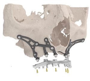 IMPIANTO SOTTOPERIOSTEO o IUXTAOSSEO