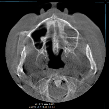 Sinusite mascellare e chiusura fistola oro-antrale con Bolla di Bichat