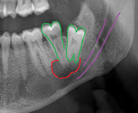 Dente del Giudizio Inferiore Distoangolato = Difficile