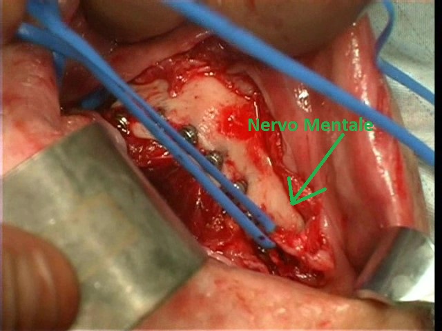Trasposizione Nervo alveolare inferiore