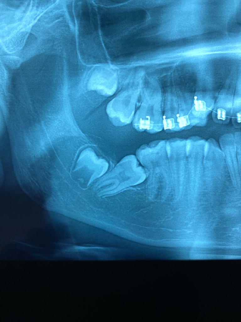 Settimo o dente del giudizio?