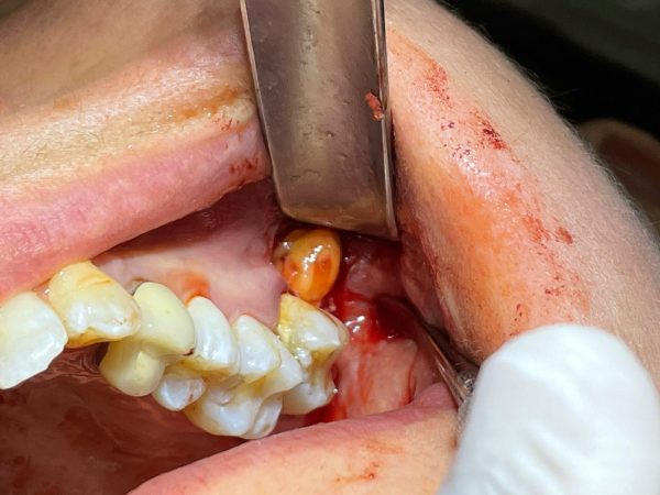 Bolla di Bichat e dente del giudizio superiore