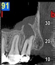 Sinusite odontogena