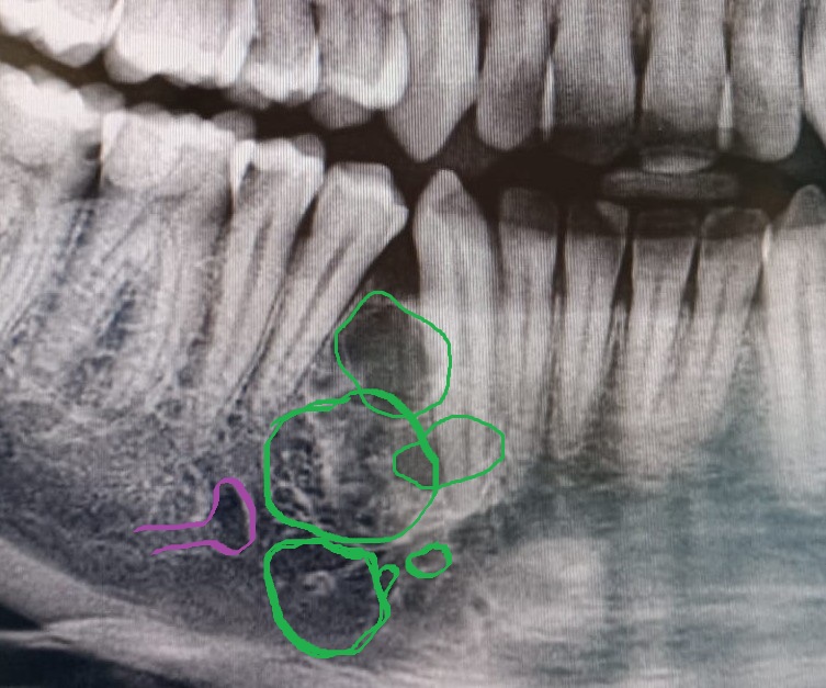 FIBROMA AMELOBLASTICO