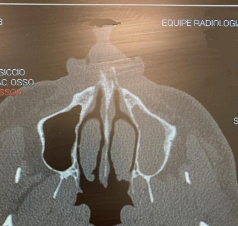 Sinusite Mascellare Odontogena e FESS