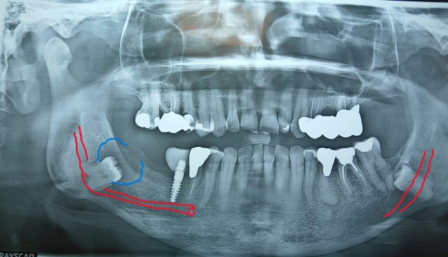 NAI,  nervo alveolare inferiore