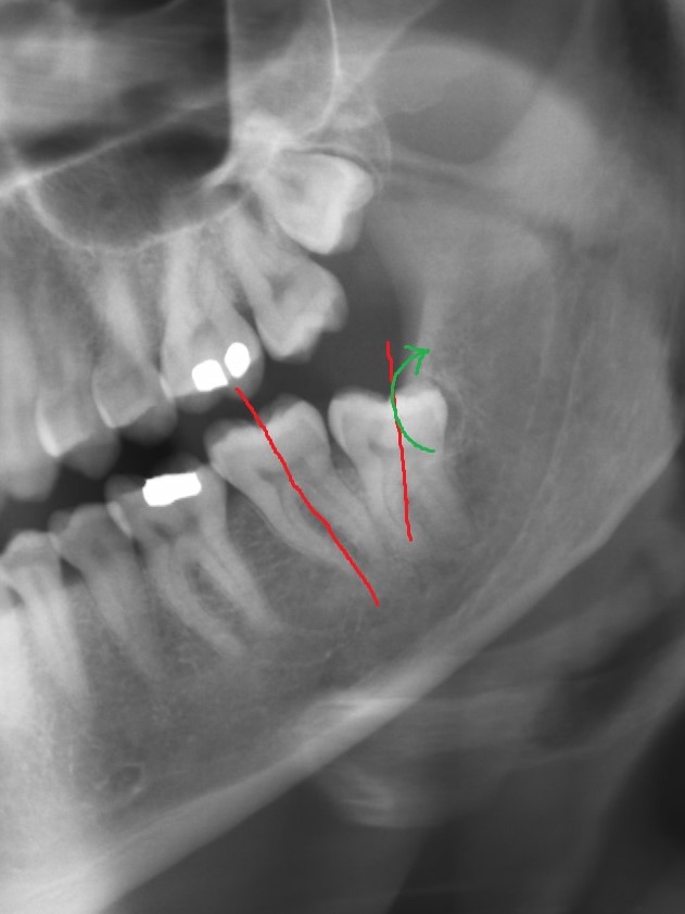 Dente del Giudizio Inferiore Distoangolato = Difficile