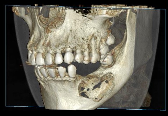 RECIDIVA DI UN   FIBROMA AMELOBLASTICO