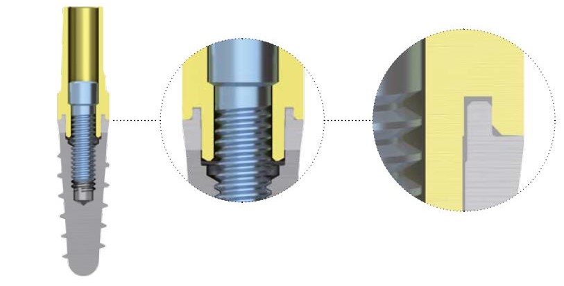 Abutment compatibili VS  abutment  originali