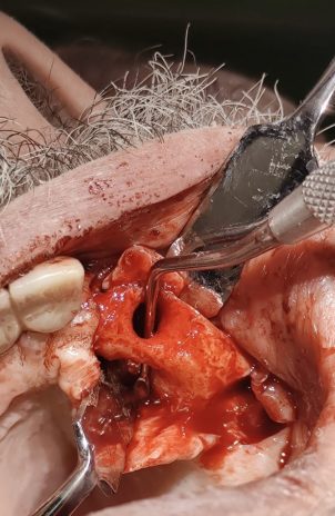 Cisti Residua e Ricostruzione cresta alveolare