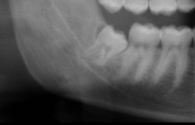 DENTI DEL GIUDIZIO E PARODONTOLOGIA