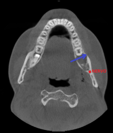 Alveolite post estrattiva zona 38 con sequestro osseo