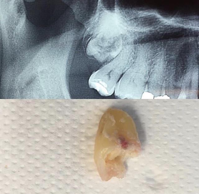 Un dente del giudizio particolare