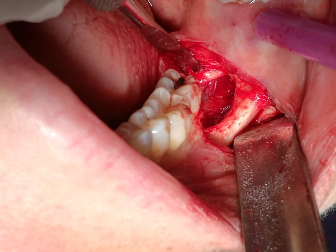 Teeth Drifting by Dr PF Amoroso