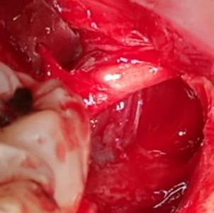 Rischi al nervo alveolare inferiore e al nervo LINGUALE