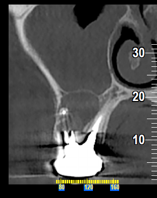Sinusite Odontogena