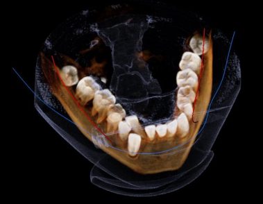 Complicanza ortodontica relativa ad una trasposizione. Canino inferiore / incisivo laterale.