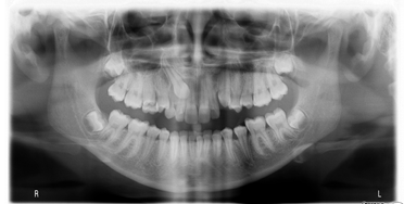 PASSO dell’impianto e velocità di rotazione del motore implantare