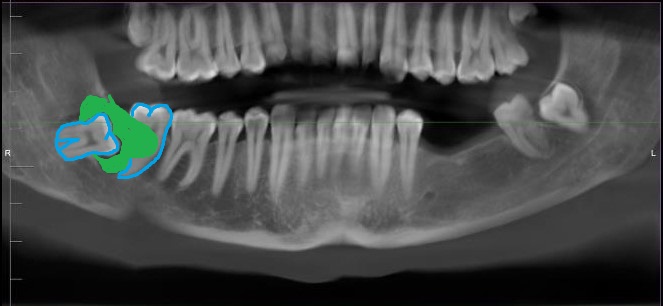Cisti e denti da estrarre