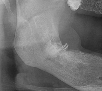Denti del Giudizio e rischio per il Nervo Alveolare Inferiore